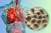 Pulmonary cryptococcosis, illustration