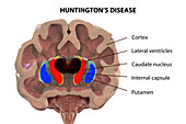 Dorsal striatum in Huntington's disease, illustration