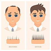 Alopecia treatment in men, illustration
