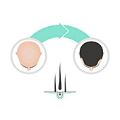 Hair transplantation in men, conceptual illustration
