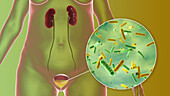 Bacterial cystitis, illustration