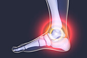 Foot pain, illustration