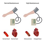 Hypertensive heart disease, illustration