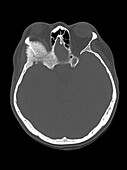 Intraosseous meningioma, CT scan