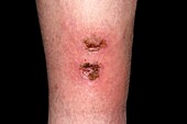 Infected wounds on leg