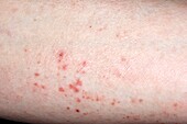 Flare-up of chronic eczema