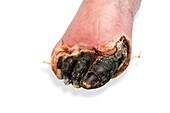 Gangrenous foot