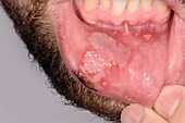 Aphthous ulcer