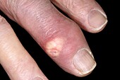 Gout tophi on a finger