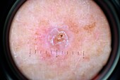 Basal cell carcinoma, dermascope image