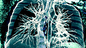 Healthy heart and lungs, CT scan
