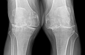 Knee osteoarthritis, X-ray