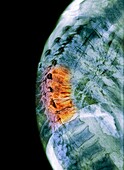 Spinal osteoporosis, X-ray