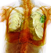 Heart failure, X-ray