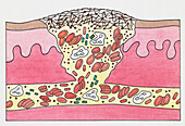 Blood clot formation, illustration