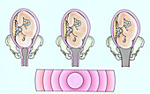 Opening of the cervix, illustration