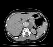 Abdominal aortic aneurysm, CT scan