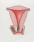 Capsules of radioactive material in vagina, illustration