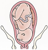 Baby with it's brow towards the womb opening, illustration