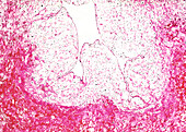 Cardiac sarcoma, light micrograph