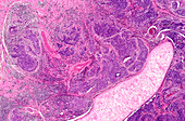 Laryngeal and pharyngeal cancer, light micrograph
