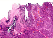 Paediatric medulloblastoma, light micrograph