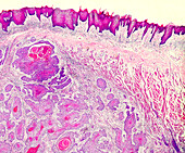 Mouth cancer, light micrograph