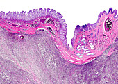 Paediatric neuroblastoma, light micrograph