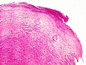 Adult neuroblastoma, light micrograph