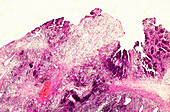 Paediatric rhabdomyosarcoma, light micrograph