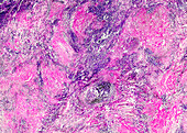 Silicosis of the lung, light micrograph