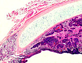 Tracheobronchial tumour, light micrograph
