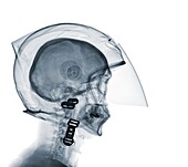 Person wearing a motorcycle helmet, X-ray