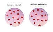 Normal and malformed red blood cells, illustration