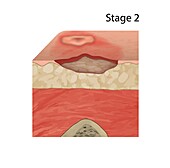 Stage 2 pressure sore, illustration