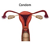 Condom contraception mechanism action, illustration