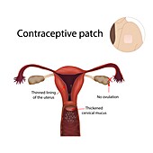 Contraceptive patch, illustration