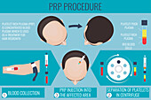 Platelet rich plasma male hair loss treatment, illustration