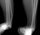Dislocated ankle, X-ray