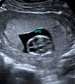 Foetal measurement, ultrasound scan