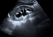 Kidney stone, ultrasound scan