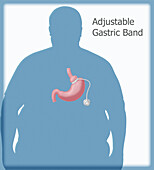 Adjustable Gastric Band