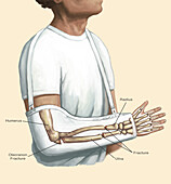Broken Arm in Cast, Illustration