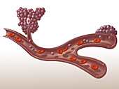 Metastasis of a Tumour, Illustration