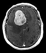 MRI Large Frontal Meningioma