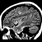 MRI Balloon Cell Cortical Dysplasia