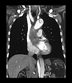 CTA Aortic Dissection