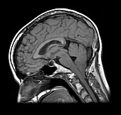 MRI Chiari I Malformation
