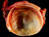 Benign Ovarian Cyst, Gross Specimen