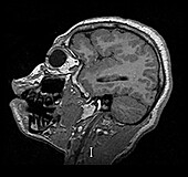MRI Congenital Brain Malformations